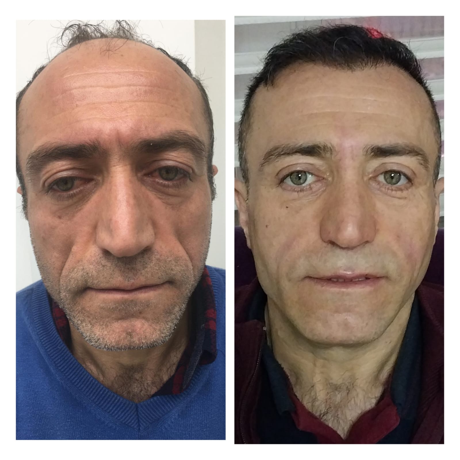 Tam Yüz Yenileme